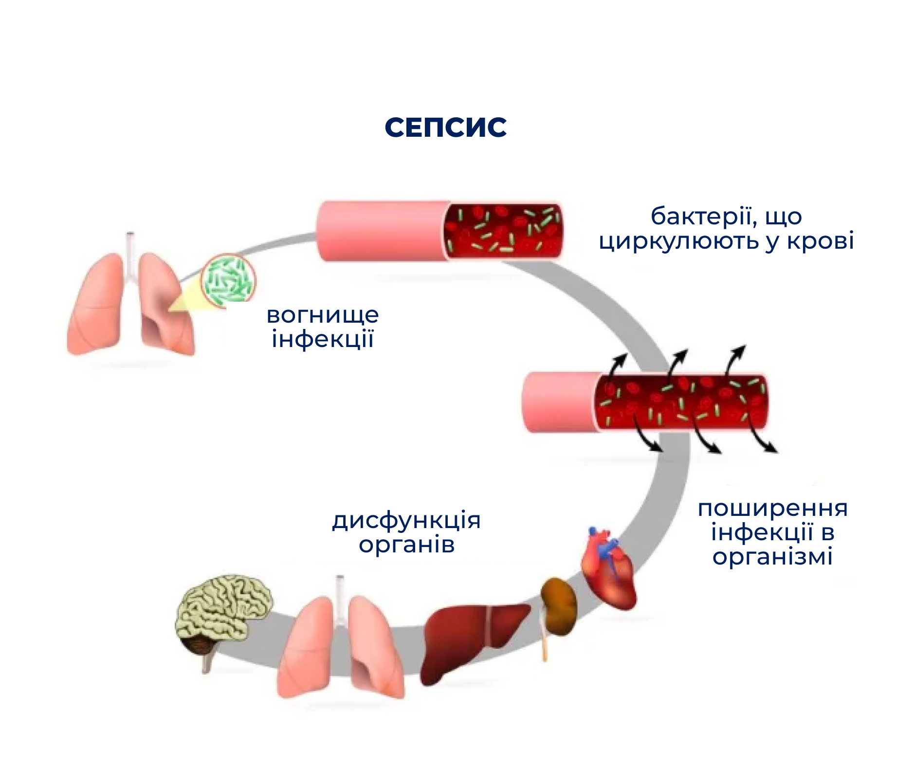 sepsis1