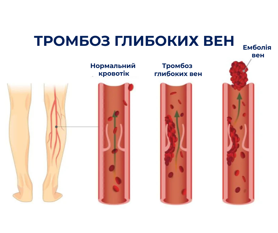 tromb stattia